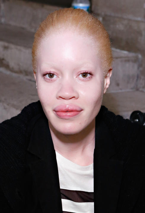El albinismo de Diandra Forrest es motivo de persecución en algunos país...